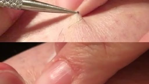 It all started with an itch, and ended in shock! A man found a black spot on his leg and started picking it off… what he removed left millions of people speechless.